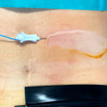 When Should You Avoid Using TENS Therapy?