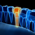 What is the Cost of Using TENS in Dentistry?