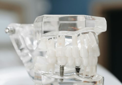 Revolutionize Your Oral Health Journey: Teeth Implants In Gainesville, VA, With TENS In Dentistry