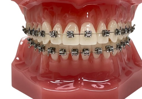 The Benefits Of Using Tens In Dentistry For Braces Patients In Austin, TX