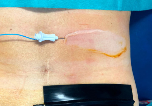 When Should You Avoid Using TENS Therapy?