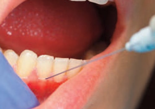 How Long Does a TENS Treatment Last in Dentistry?