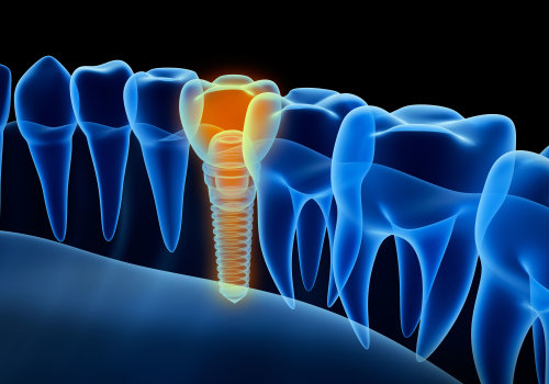 What is the Cost of Using TENS in Dentistry?